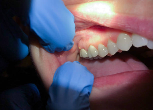 Best Urgent Care for Lost Fillings or Crowns in Stafford Springs, CT